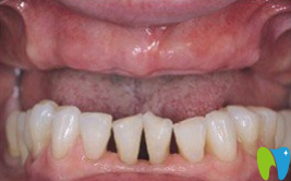 廈門登特口腔80歲老人種植牙前