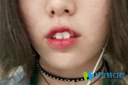 在九江奇洋口腔做了牙齒矯正，我擺脫了“兔牙妹”稱(chēng)號(hào)