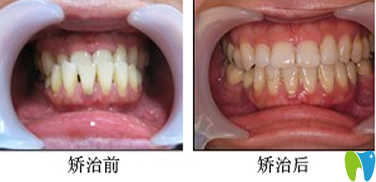 拜博拜爾口腔楊國(guó)平醫(yī)生隱形矯正牙齒效果圖