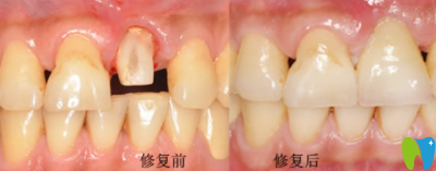 寧波拜博拜爾口腔林玉貴前牙美學(xué)修復(fù)效果圖