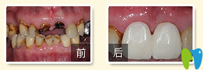 廣州德倫口腔東風(fēng)旗艦院徐世同門牙種植案例