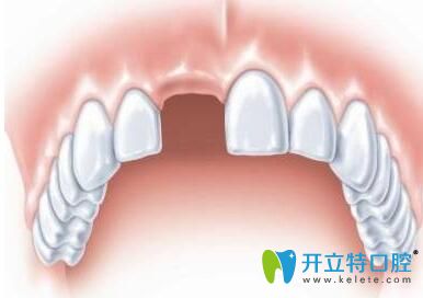 門牙缺失的趙先生在玉溪舒爾口腔做種植牙修復成功