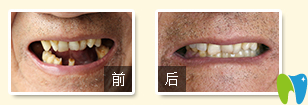 廣州德倫口腔東風(fēng)旗艦院徐世同無痛種植牙案例圖