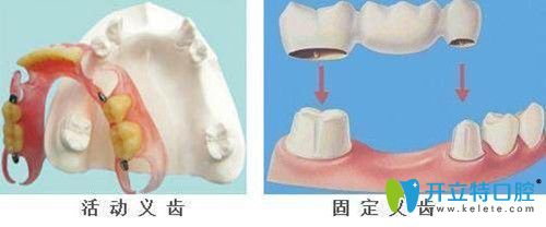 固定義齒