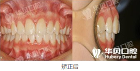 在濰坊華貝口腔做了牙齒矯正，恢復(fù)后我擺脫了齙牙妹