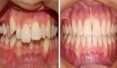 隱形矯正有用嗎？看自貢新橋口腔3D數(shù)碼隱形矯正案例效果