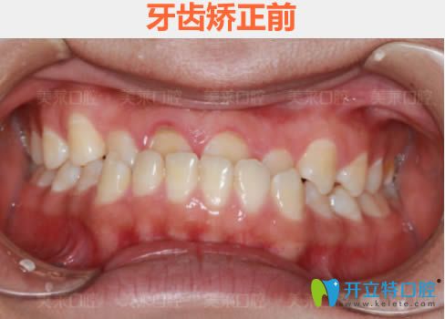 我看過廣州美萊和曙光口腔科的價格后,去美萊做了牙齒矯正