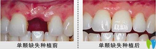 北京嘉和口腔郝國(guó)瑋醫(yī)生種植牙前后效果對(duì)比圖