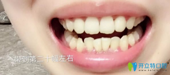 瑞德口腔矯正牙齒14個月恢復(fù)效果