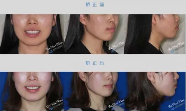 看26歲的小姜在上?？仆啐X科牙齒矯正案例 效果堪比整形哦