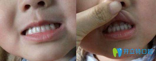 3歲女兒去西安雁塔惟真口腔做牙齒矯正前的圖片