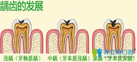 兒童齲齒怎么治療多少錢？齲齒治療預防方法及費用大全