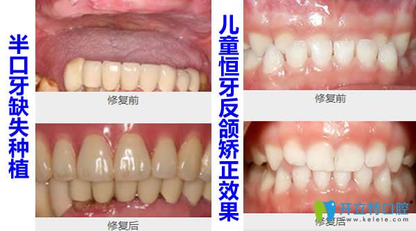 松豐口腔半口牙缺失種植+牙齒反頜正畸效果案例