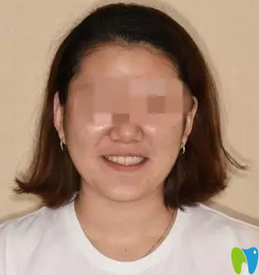 我在沈陽(yáng)康貝佳口腔做牙齒矯正一年的效果