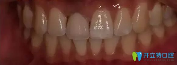 北京永康口腔門牙缺失修復后效果