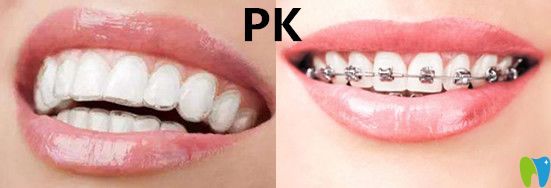 隱形矯正VS傳統(tǒng)牙套哪種效果？有什么區(qū)別呢？