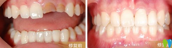 陽光樹口腔烤瓷牙修復(fù)前后效果對(duì)比