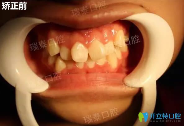 記錄我去西安瑞泰口腔做時(shí)代天使隱形矯正14個(gè)月以來的感受