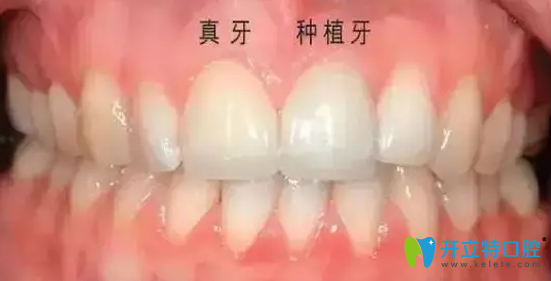 齒康口腔牙齒種植后