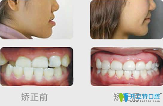 維樂口腔牙齒矯正前后效果對(duì)比圖