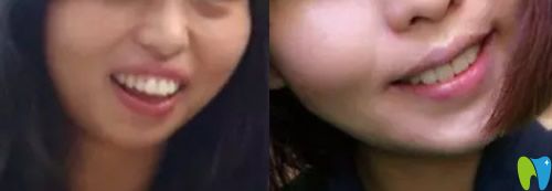 重慶牙科哪家好，看美維口腔齙牙矯正案例效果圖