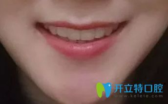 結(jié)束正畸，戴保持器圖片