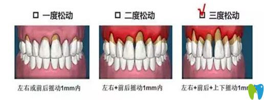 牙齒松動(dòng)治療辦法和松動(dòng)程度有關(guān)