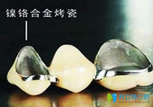 網(wǎng)上說鎳鉻烤瓷牙會致癌是真的嗎？揭秘鎳鉻烤瓷牙的危害