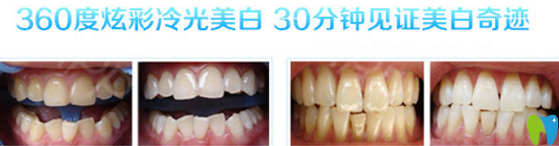 福州哪家牙科好？看貝臣齒科冷光美白案例來證明