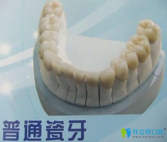 普通烤瓷牙多少錢(qián)一顆及能用多久 點(diǎn)擊這里有你想知道的