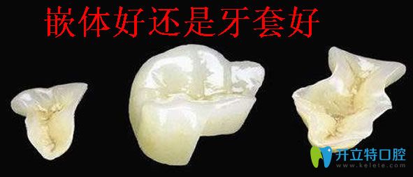 牙齒嵌體和牙套那個(gè)好 分享嵌體補(bǔ)牙能維持多久及修復(fù)價(jià)格