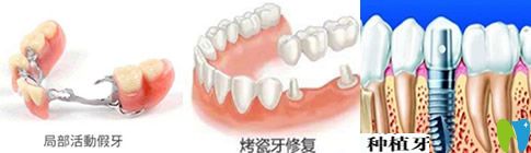 種植牙、活動假牙和烤瓷牙哪個好？看完你就會明白哦