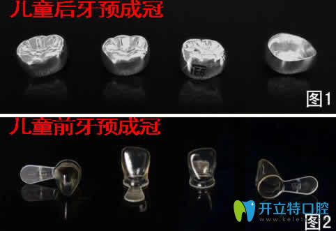 兒童預(yù)成冠對(duì)牙齒有沒(méi)有危害及戴預(yù)成冠后注意事項(xiàng)的詳解