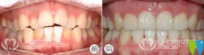 西安優(yōu)德口腔<!--<i data=20240703-sp></i>-->院長(zhǎng)隱形牙齒矯正案例效果圖