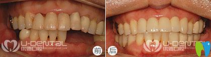 優(yōu)德口腔微創(chuàng)種植牙案例圖