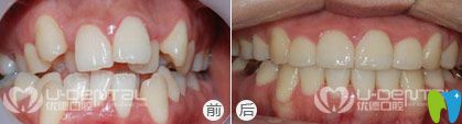 優(yōu)德口腔隱形矯正案例效果圖