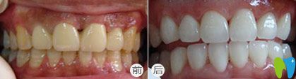 西安優(yōu)典口腔牙齒美白前后對(duì)比圖
