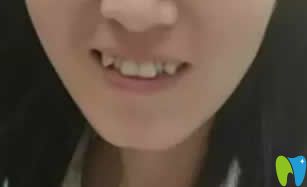 牙齒矯正改變臉型嗎？附我在西安優(yōu)德口腔正畸15個月效果圖