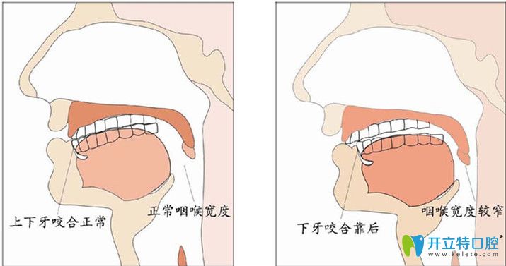 什么是咬合關系，你的咬合關系是否正常呢？