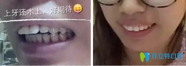 聽(tīng)說(shuō)長(zhǎng)春欣雅和拜博的價(jià)格不貴,就去欣雅口腔做了舌側(cè)矯正