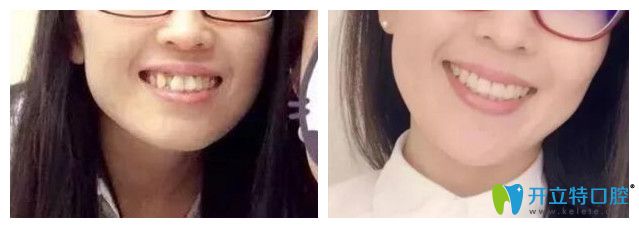 青島維樂口腔<!--<i data=20240703-sp></i>-->牙齒矯正怎么樣？案例效果來驗(yàn)證