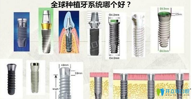 種植牙系統(tǒng)哪個好？來看世界種植體排名詳情及價格表