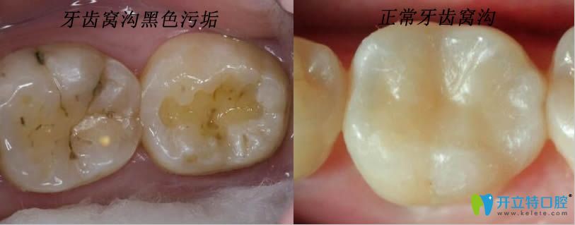 牙齒上的黑色污垢是蛀牙嗎？那蛀牙如何讓它停止腐蝕呢？