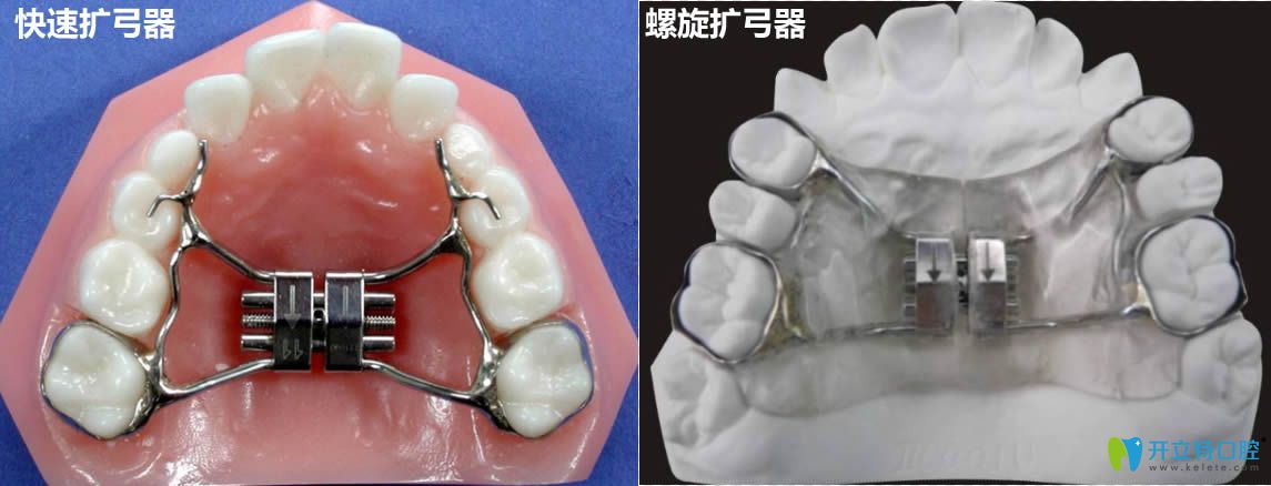 揭開牙齒擴(kuò)弓后非常后悔的真相 其實(shí)拔牙和擴(kuò)弓各有利弊