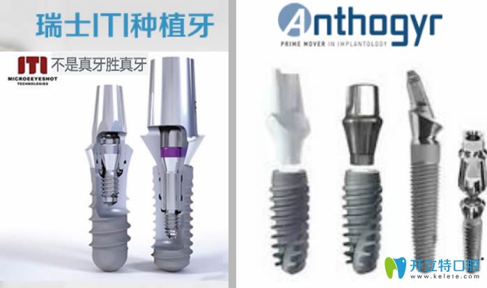解析法國安卓健和瑞士iti哪個好?奉上iti和Anthogyr種植體價格