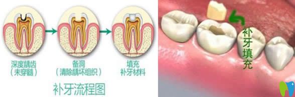 有關(guān)補(bǔ)牙會(huì)不會(huì)越補(bǔ)越爛和千萬(wàn)不要去補(bǔ)牙的真相大揭秘