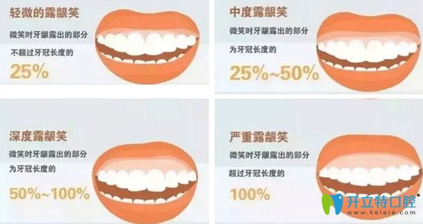 露齦笑可以矯正嗎？公布露齦笑手術(shù)費(fèi)用及矯正前后對比照