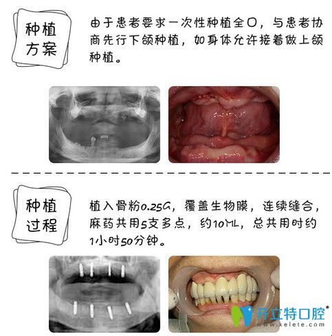 東莞好百年口腔怎么樣？60歲老人全口牙種植案例見(jiàn)證