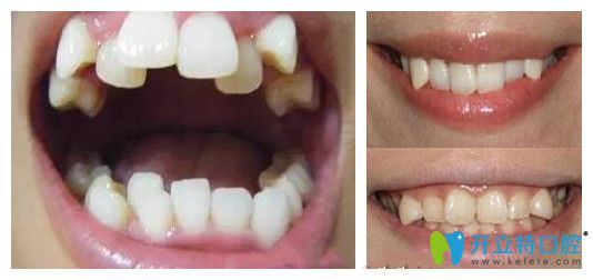 談?wù)劙酥佚X是什么意思以及虎牙和八重牙有區(qū)別嗎？