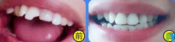 全瓷牙前后對(duì)比圖